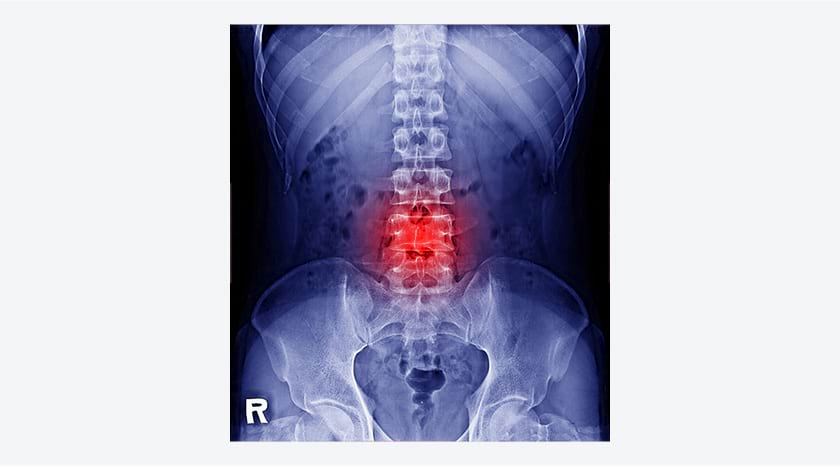 DEXA骨質密度掃描或可免費 骨質疏鬆患者宜每1-2年覆診跟進治療方案