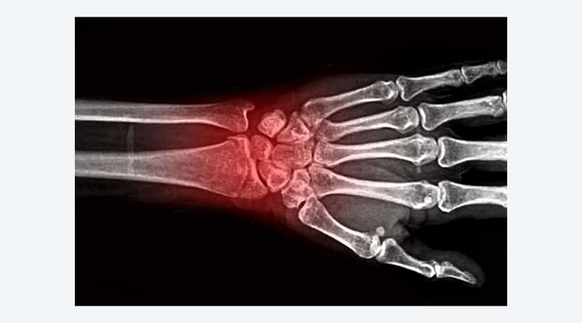 DEXA骨質密度掃描或可免費 骨質疏鬆患者宜每1-2年覆診跟進治療方案