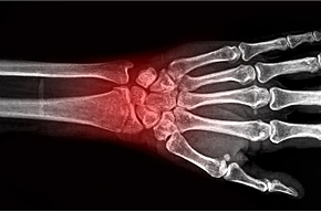 DEXA骨質密度掃描或可免費 骨質疏鬆患者宜每1-2年覆診跟進治療方案