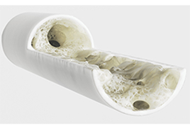 嚴重的骨質疏鬆